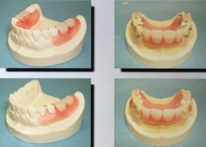 バルプラスト義歯