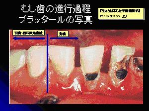 虫歯の進行過程