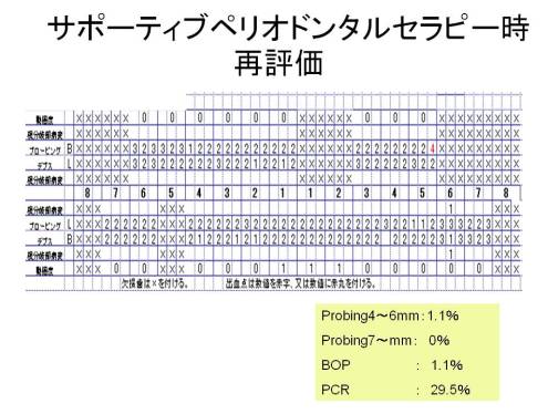 サポーティブペリオドンタルセラピー時 サポーティブペリオドンタルセラピー時