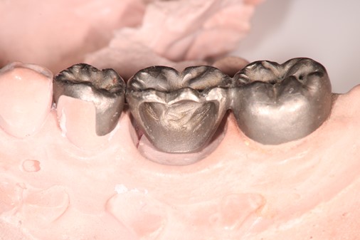 ピンレッジや5分の4冠 ピンレッジや5分の4冠