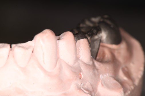 ピンレッジや5分の4冠 ピンレッジや5分の4冠