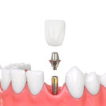 上顎の奥歯に歯がなくインプラントがしたいです