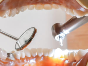 歯周病のレーザー治療について