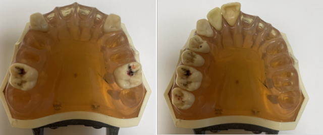 入れ歯を入れるほうの顎(受圧側)