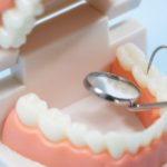 インプラントは虫歯になりますか？