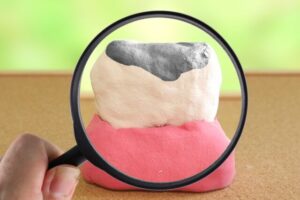 「アマルガム」をご存知ですか？