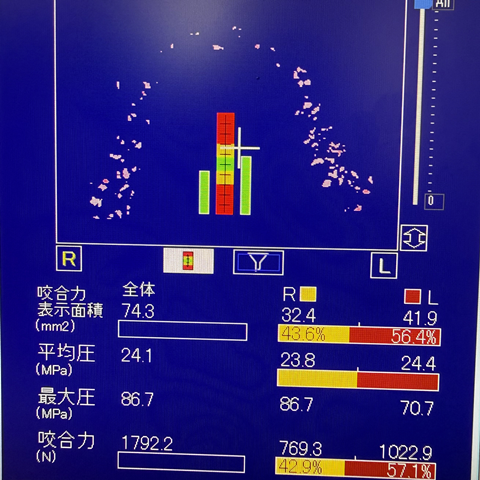 噛む力の検査 噛む力の検査